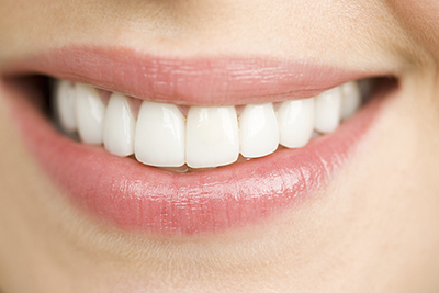 Close up of woman smiling after getting dental veneers at Frank Dunlap, DDS in Houston, TX.