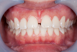 Close-up of teeth with a gap at Frank Dunlap, DDS
