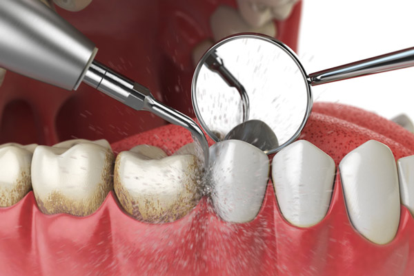 Rendering of teeth and gum cleaning with dental tools