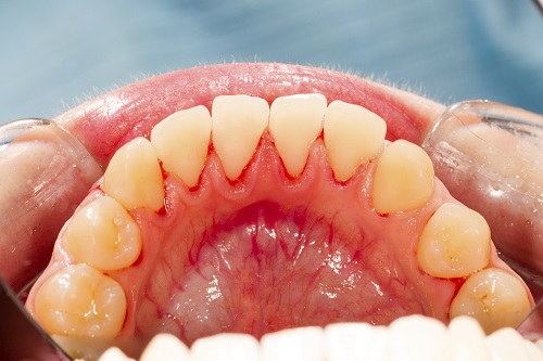 Understanding Periodontal Disease
