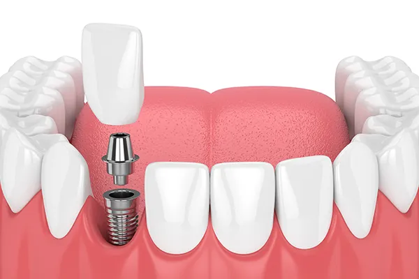 A front tooth dental implant, showing the implant post, abutment, and crown being assembled in the upper jaw.